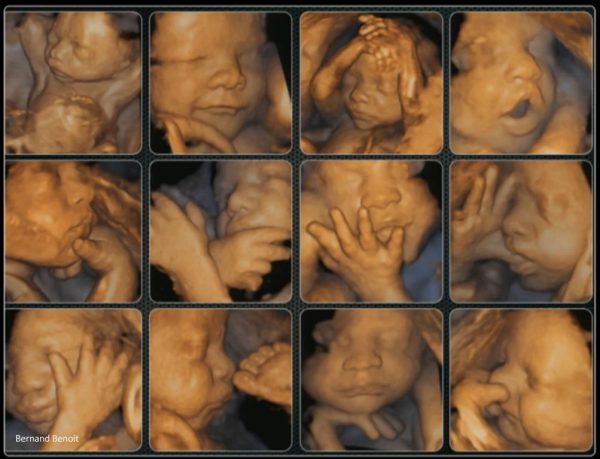 سونوگرافی سه بعدی و چهاربعدی جنین در تهران