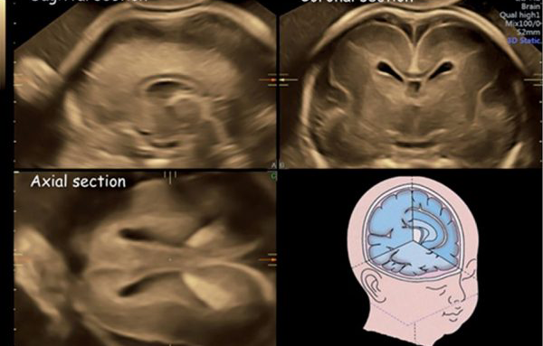 نوروسونوگرافی (Neurosonography) یا سونوگرافی مغز جنین چیست؟