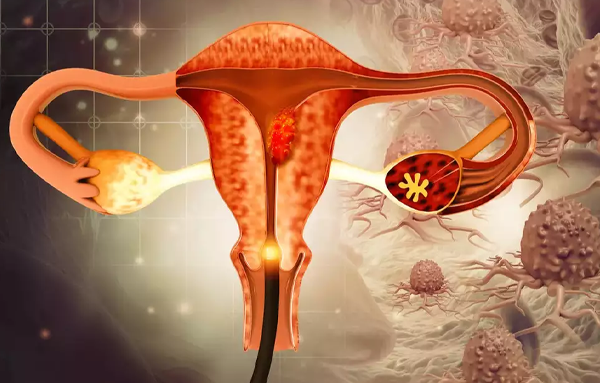سرطان تخمدان: علائم، تشخیص و درمان