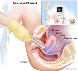 سونوهیستروگرافی در بارداری